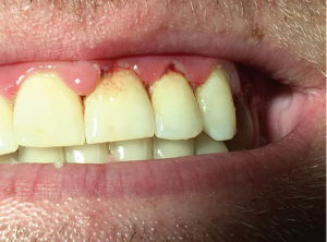 Tandvleesontsteking / gingivitis Huisartsgeneeskunde