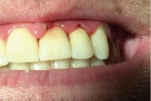 Tandvleesontsteking / gingivitis Huisartsgeneeskunde