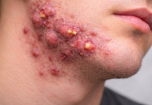 Acne conglobata