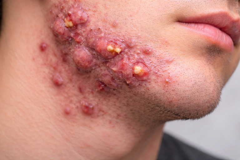 Acne conglobata