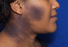 Acanthosis nigricans