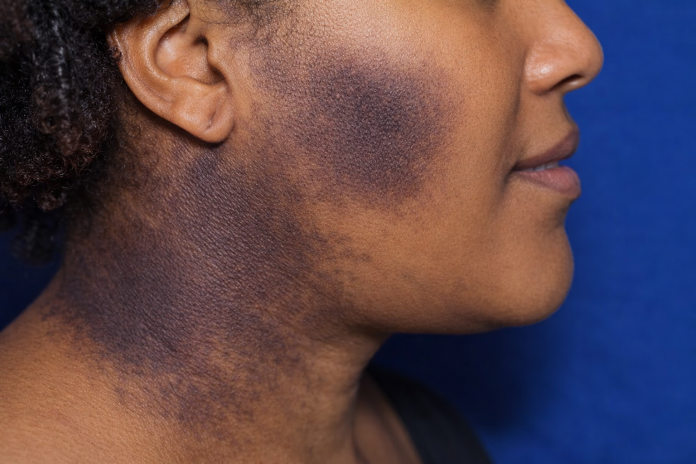acanthosis-nigricans