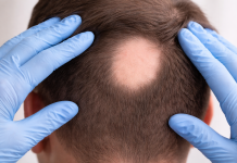 Alopecia areata