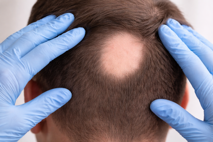 alopecia-areata