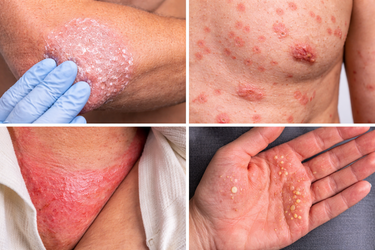 Overzicht van psoriasis