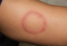 Granuloma annulare of ringworm? Vier kenmerken die helpen bij een snelle diagnose